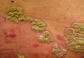 Extended data support ixekizumab for plaque psoriasis